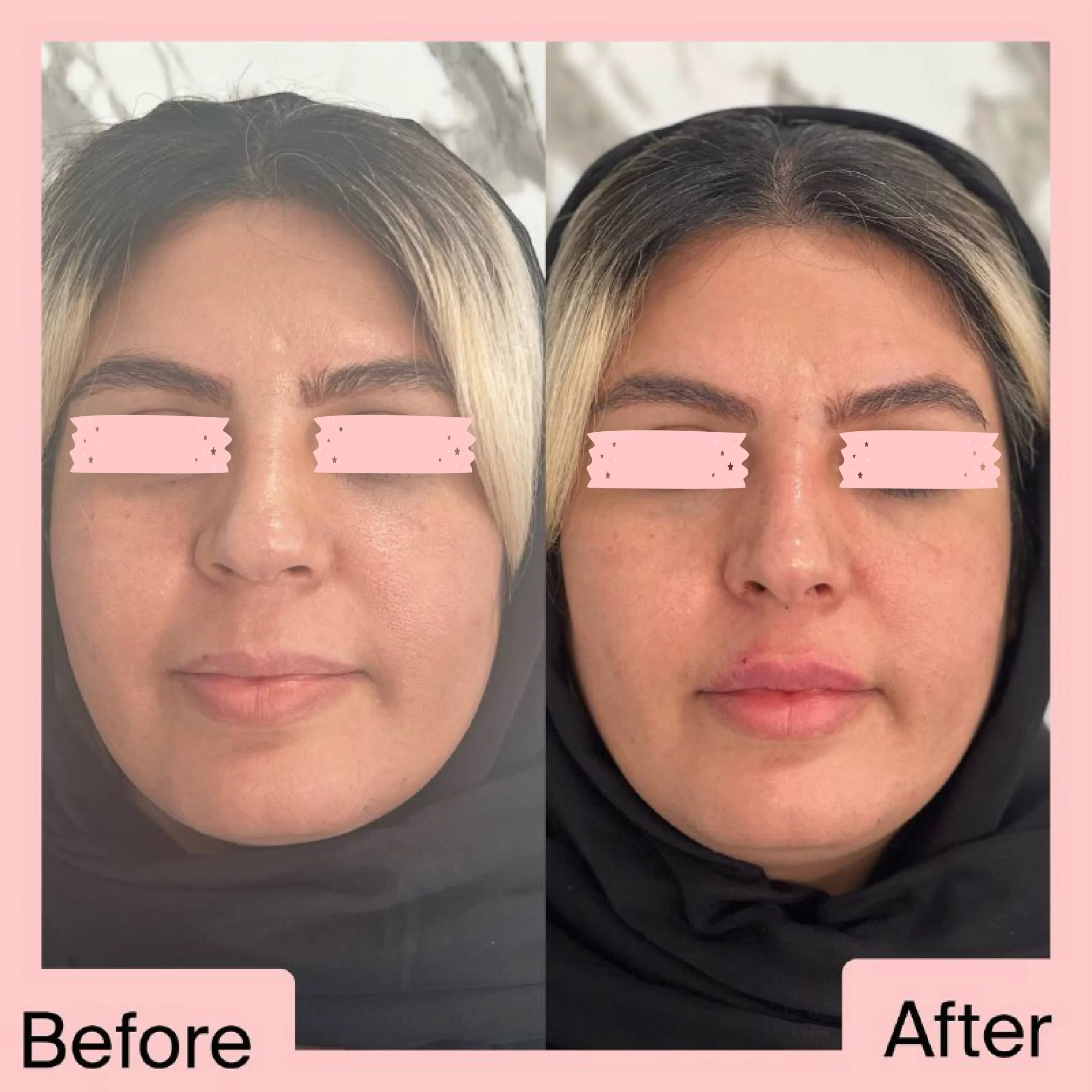 تزریق لب
